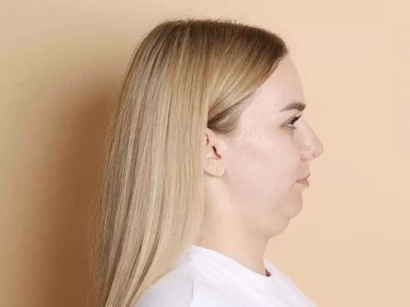 double-chin-gidi-ameliyati